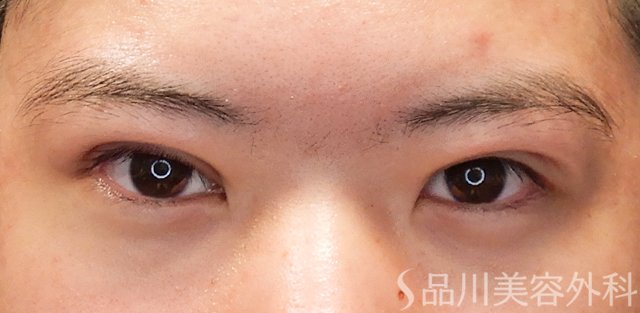 症例NO.72454のAFTER写真