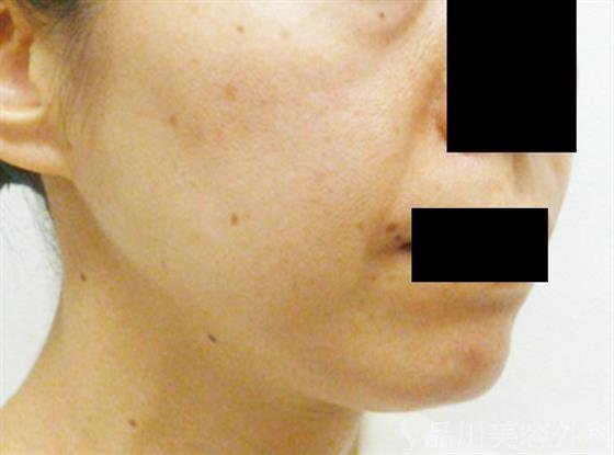 症例NO.24299のBEFORE写真
