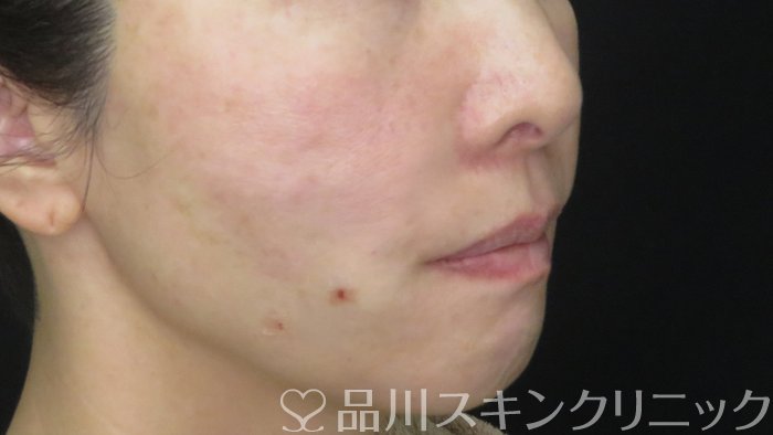 症例NO.71677のAFTER写真