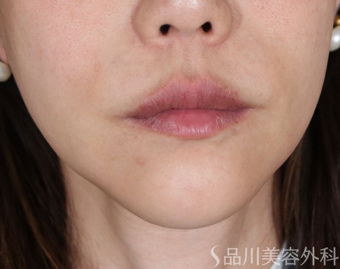 症例NO.73649のBEFORE写真