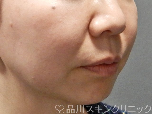 症例NO.63368のBEFORE写真