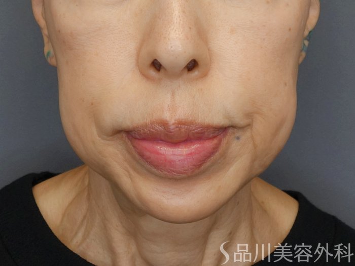 症例NO.72641のBEFORE写真