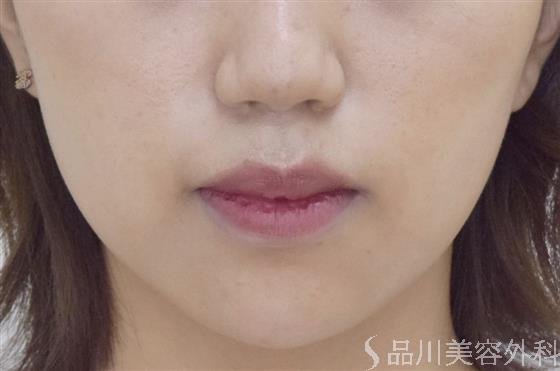 症例NO.49292のAFTER写真