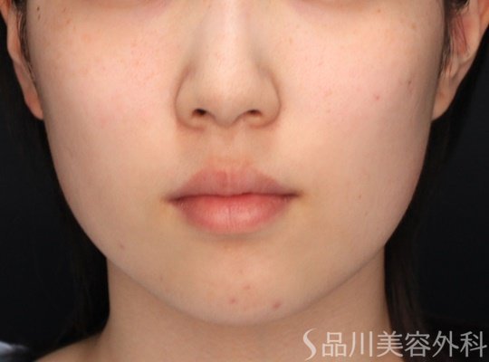 症例NO.66496のBEFORE写真