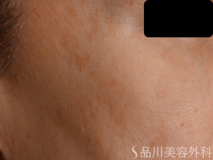 症例NO.62480のBEFORE写真