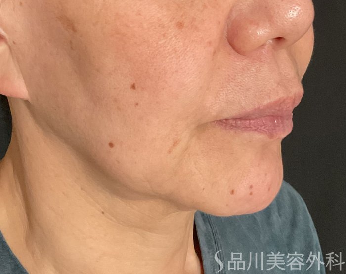 症例NO.74908のBEFORE写真