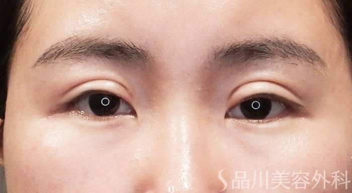 症例NO.69335のAFTER写真