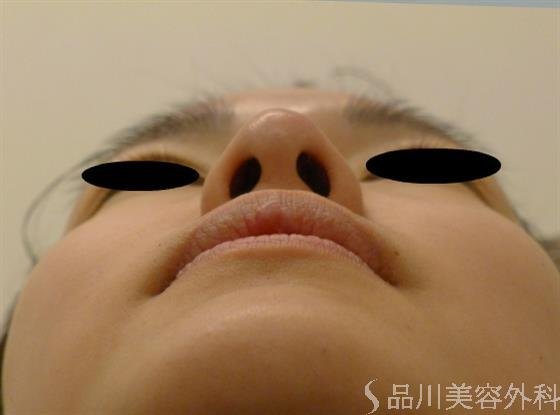 症例NO.50112のAFTER写真