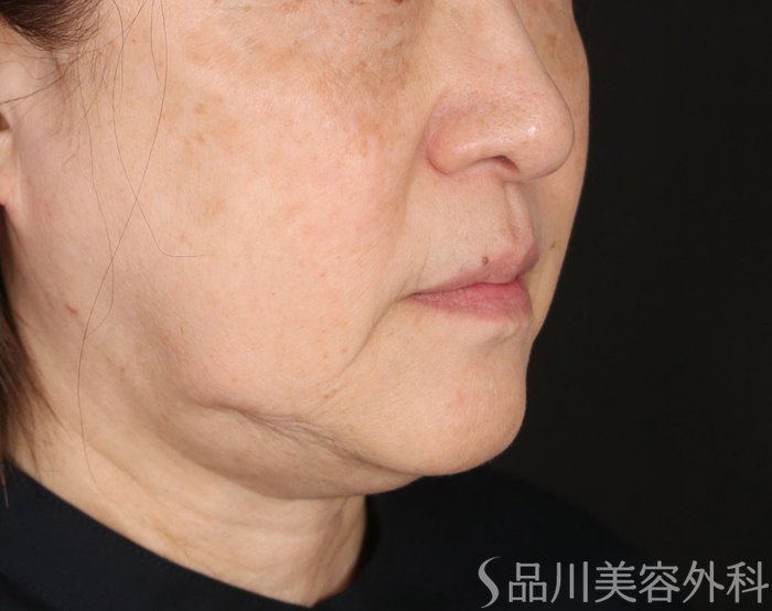 症例NO.72958のBEFORE写真