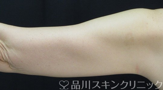 症例NO.71721のAFTER写真