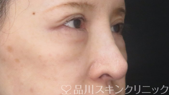 症例NO.72715のBEFORE写真