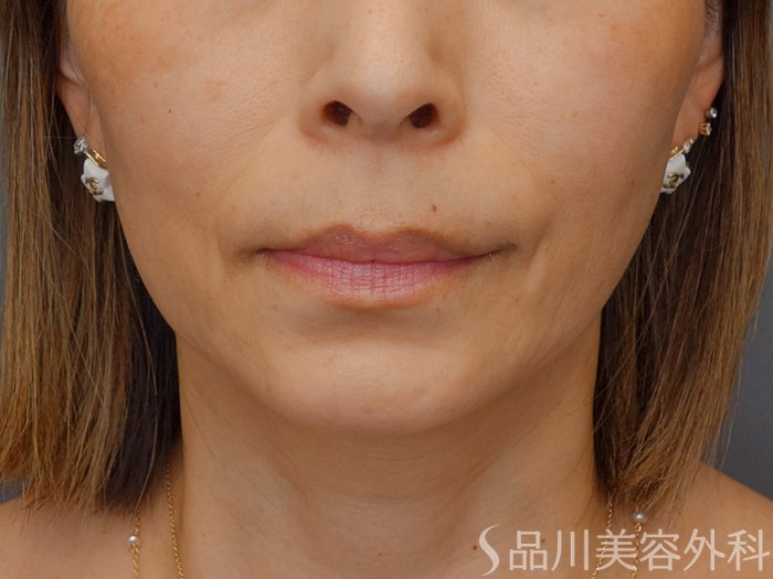 症例NO.71205のBEFORE写真