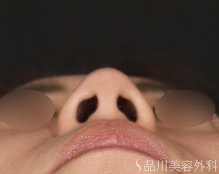 症例NO.71197のAFTER写真