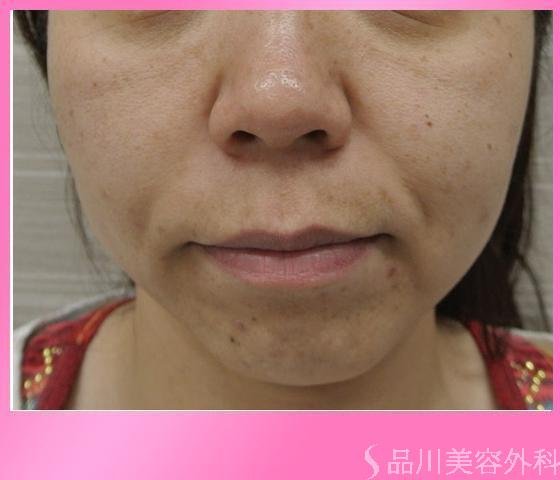 症例NO.11640のBEFORE写真