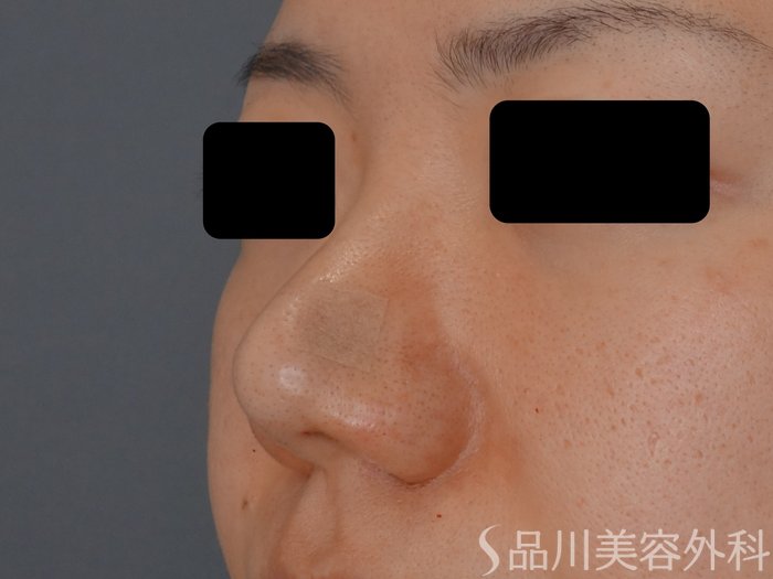 症例NO.72263のAFTER写真