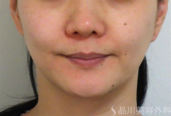 症例NO.40839のBEFORE写真