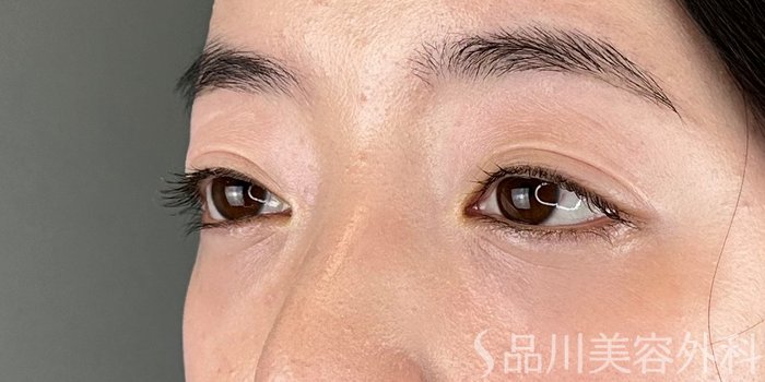 症例NO.72838のAFTER写真