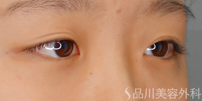 症例NO.69845のBEFORE写真