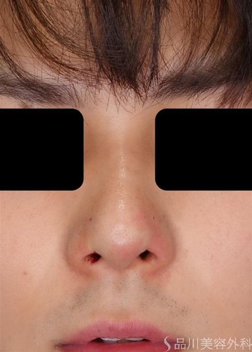 症例NO.51202のAFTER写真
