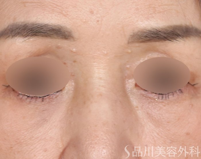 症例NO.72436のBEFORE写真