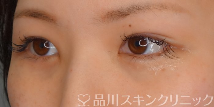 症例NO.73205のAFTER写真