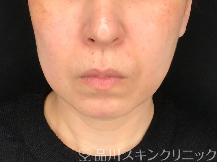 症例NO.64928のBEFORE写真