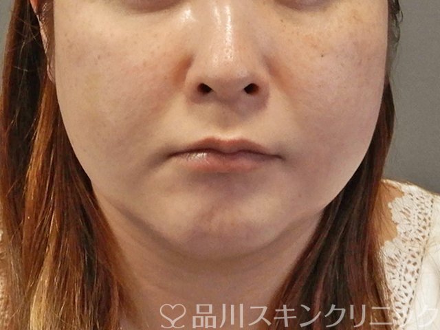症例NO.65463のBEFORE写真