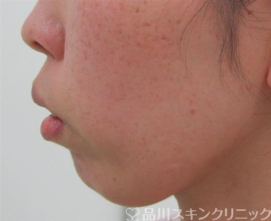 症例NO.34452のBEFORE写真