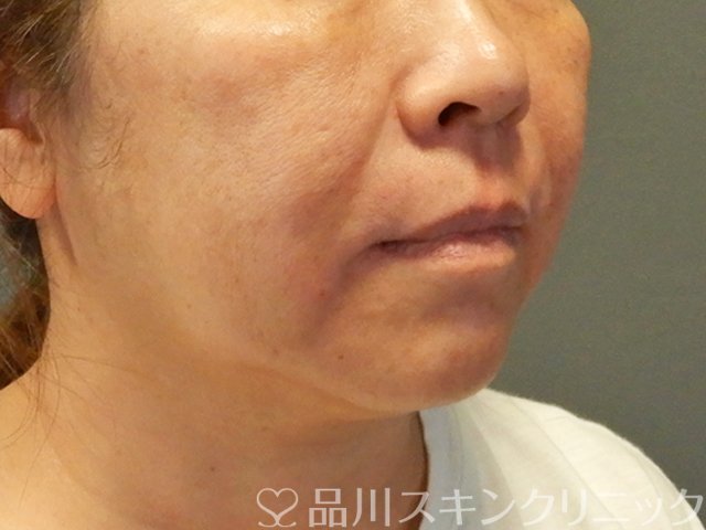 症例NO.66459のAFTER写真