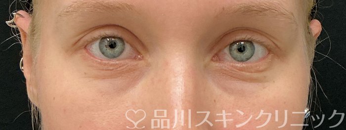 症例NO.75038のBEFORE写真