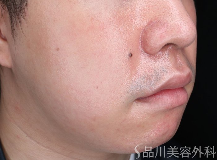 症例NO.70272のAFTER写真