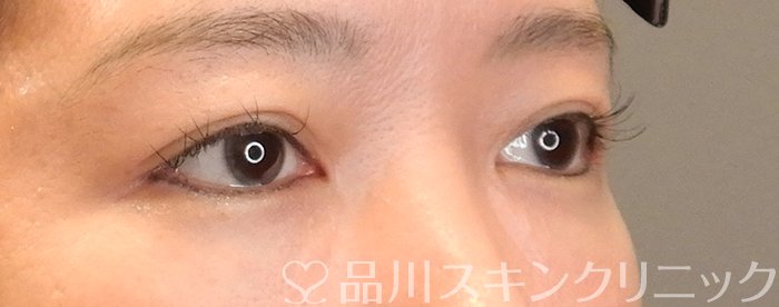 症例NO.65534のAFTER写真