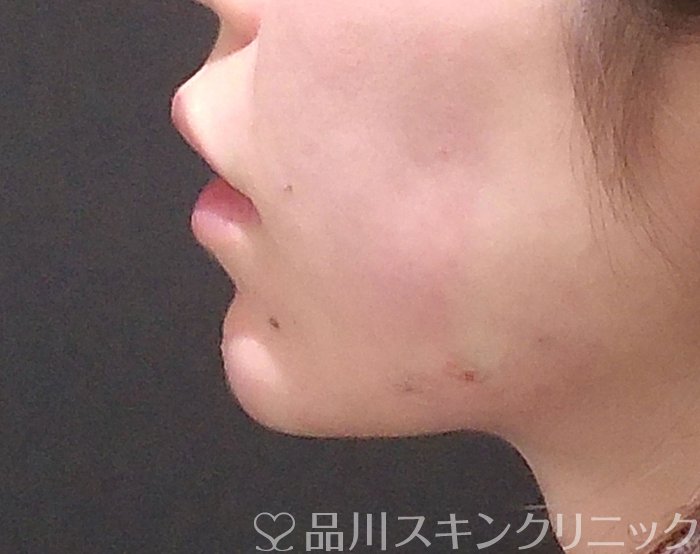 症例NO.65773のAFTER写真