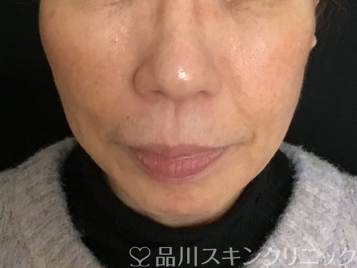 症例NO.65386のBEFORE写真