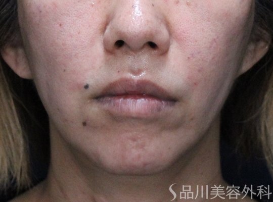 症例NO.73347のAFTER写真