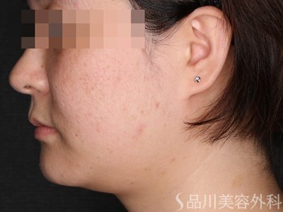 症例NO.74017のAFTER写真