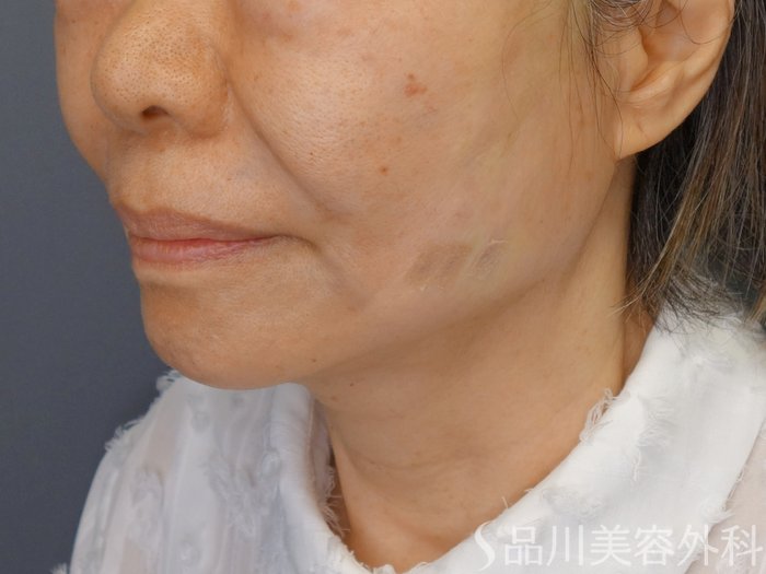 症例NO.70101のAFTER写真