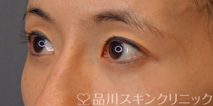 症例NO.74054のBEFORE写真