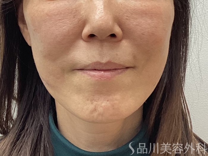 症例NO.69548のAFTER写真