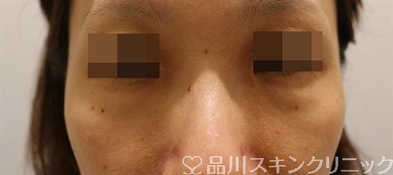 症例NO.43930のBEFORE写真