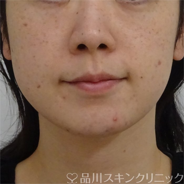 症例NO.70610のBEFORE写真