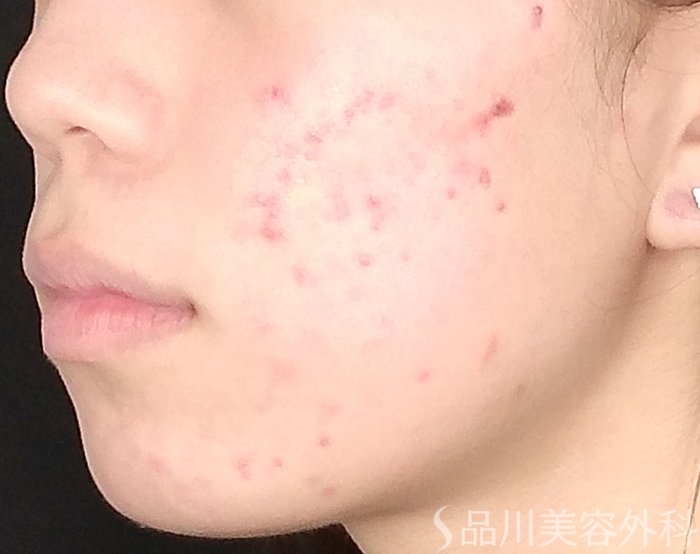 症例NO.72189のBEFORE写真