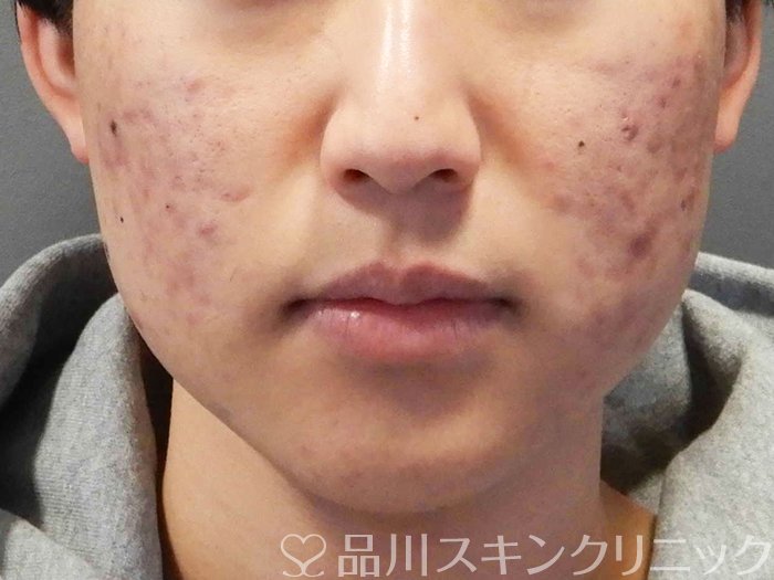 症例NO.65170のBEFORE写真