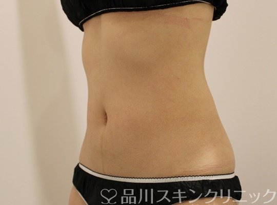 症例NO.75384のAFTER写真