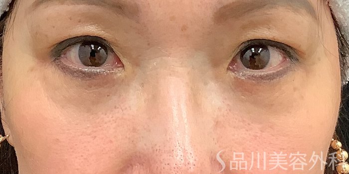症例NO.71228のAFTER写真