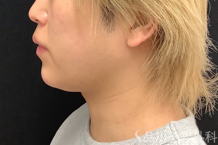 症例NO.75333のAFTER写真