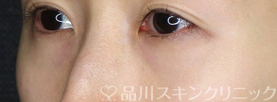 症例NO.72161のBEFORE写真