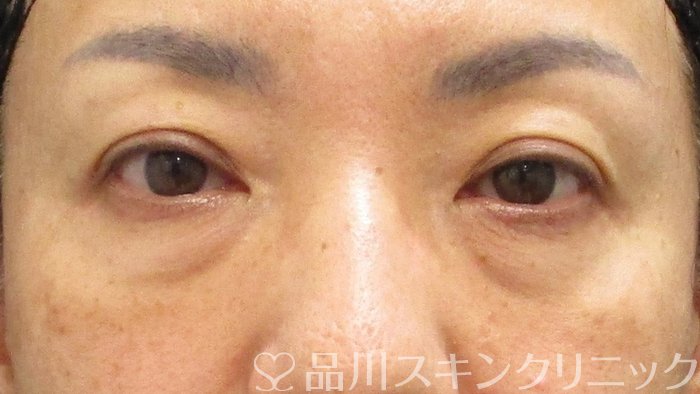 症例NO.73045のBEFORE写真