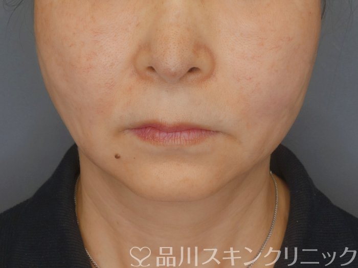 症例NO.72260のAFTER写真