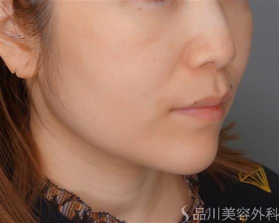 症例NO.53830のBEFORE写真